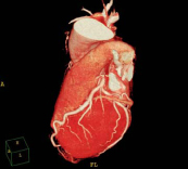 心臓3次元画像（CT）