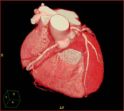 心臓3次元画像（CT）