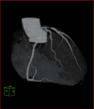 左冠状動脈　心血管解析（CT）